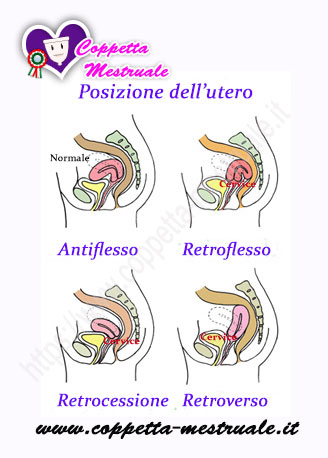 utero retroverso e coppetta mestruale